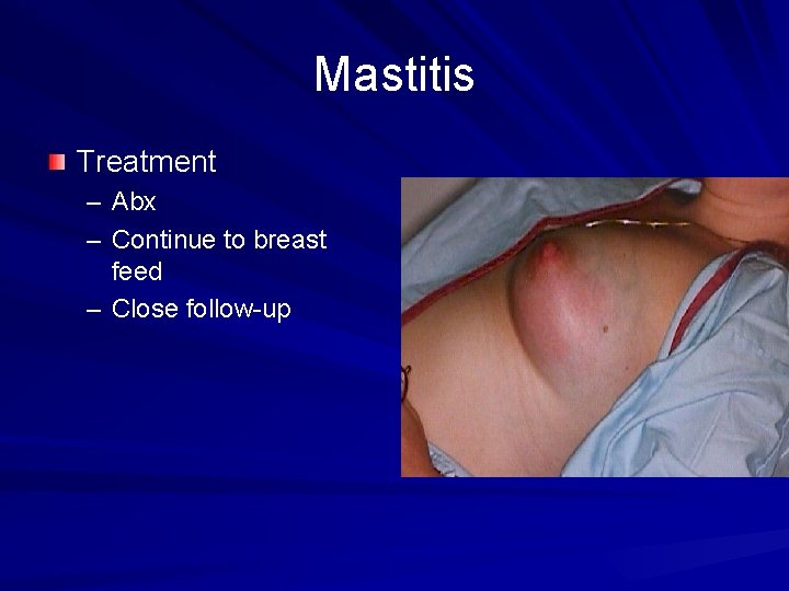 Mastitis Treatment – Abx – Continue to breast feed – Close follow-up 