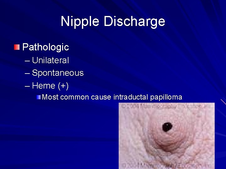 Nipple Discharge Pathologic – Unilateral – Spontaneous – Heme (+) Most common cause intraductal