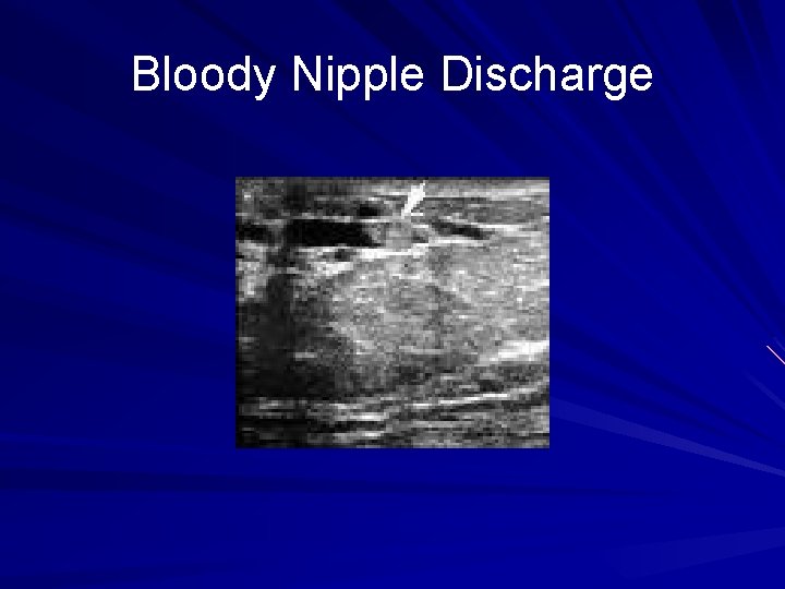 Bloody Nipple Discharge 