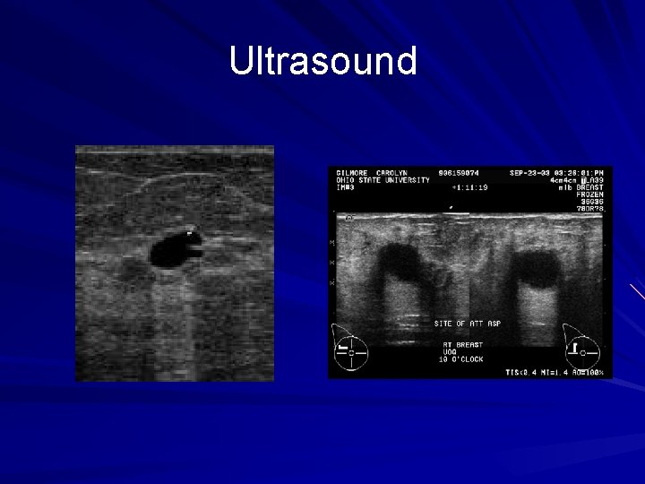 Ultrasound 