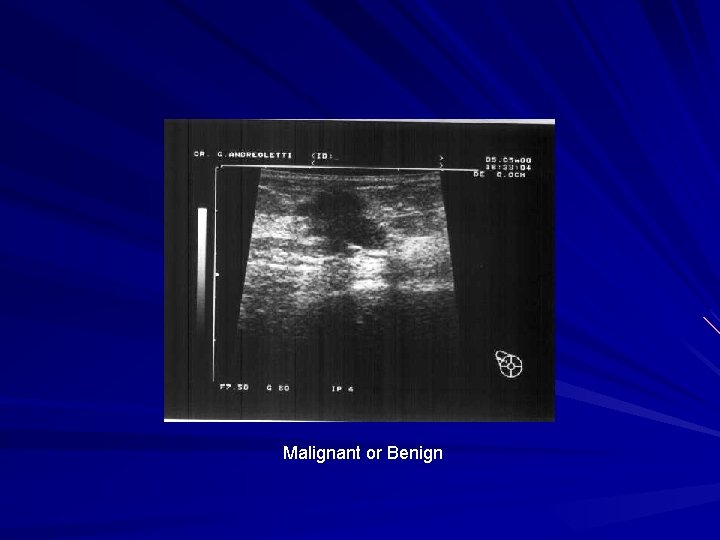 Malignant or Benign 