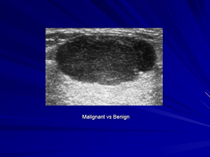 Malignant vs Benign 