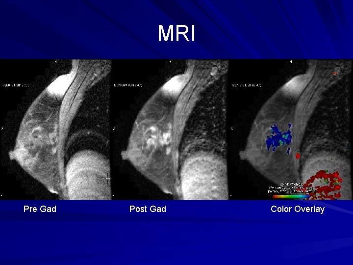 MRI Pre Gad Post Gad Color Overlay 
