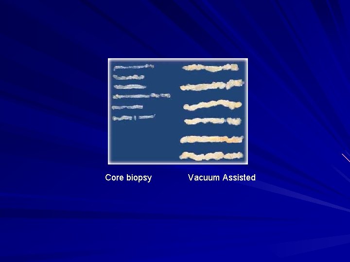 Core biopsy Vacuum Assisted 