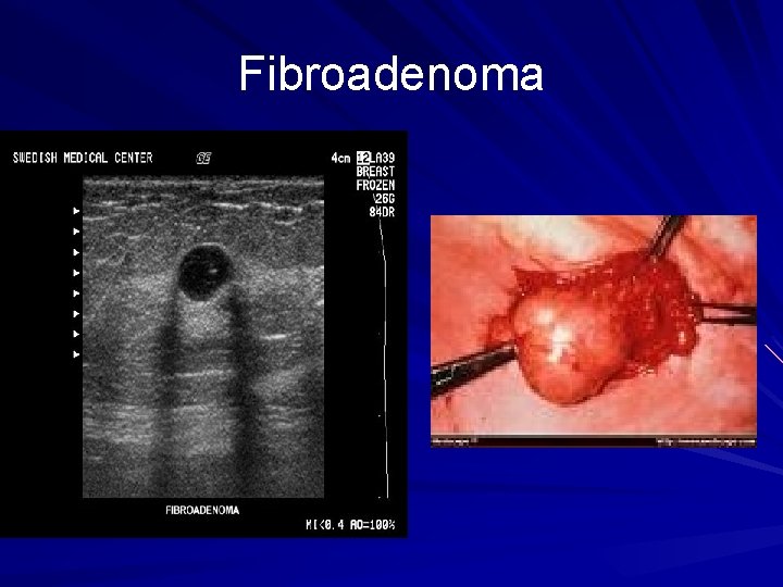 Fibroadenoma 