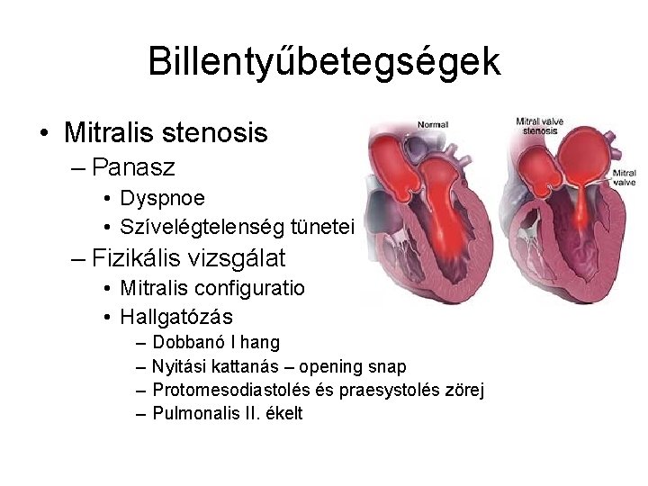 Billentyűbetegségek • Mitralis stenosis – Panasz • Dyspnoe • Szívelégtelenség tünetei – Fizikális vizsgálat