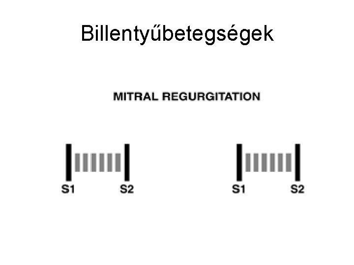 Billentyűbetegségek 