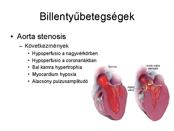 Billentyűbetegségek • Aorta stenosis – Következmények • • • Hypoperfusio a nagyvérkörben Hypoperfusio a