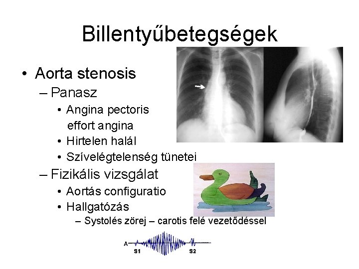 Billentyűbetegségek • Aorta stenosis – Panasz • Angina pectoris effort angina • Hirtelen halál