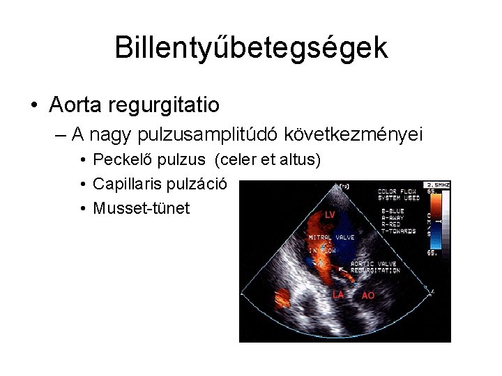 Billentyűbetegségek • Aorta regurgitatio – A nagy pulzusamplitúdó következményei • Peckelő pulzus (celer et