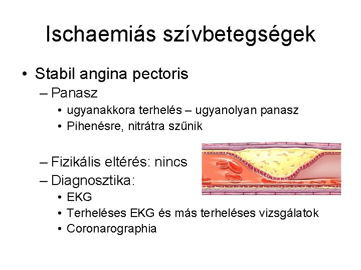 Ischaemiás szívbetegségek • Stabil angina pectoris – Panasz • ugyanakkora terhelés – ugyanolyan panasz
