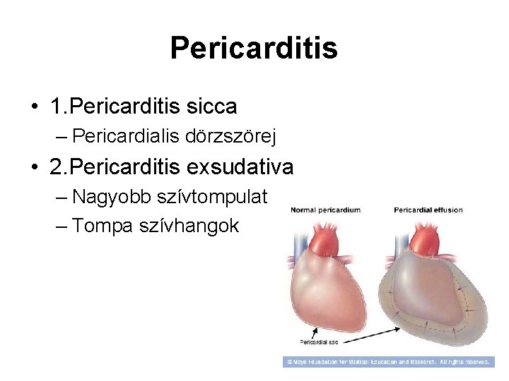 Pericarditis • 1. Pericarditis sicca – Pericardialis dörzszörej • 2. Pericarditis exsudativa – Nagyobb