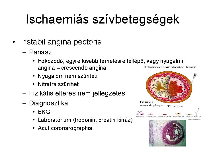 Ischaemiás szívbetegségek • Instabil angina pectoris – Panasz • Fokozódó, egyre kisebb terhelésre fellépő,