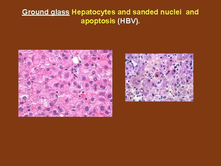 Ground glass Hepatocytes and sanded nuclei and apoptosis (HBV). 