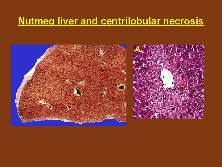 Nutmeg liver and centrilobular necrosis 