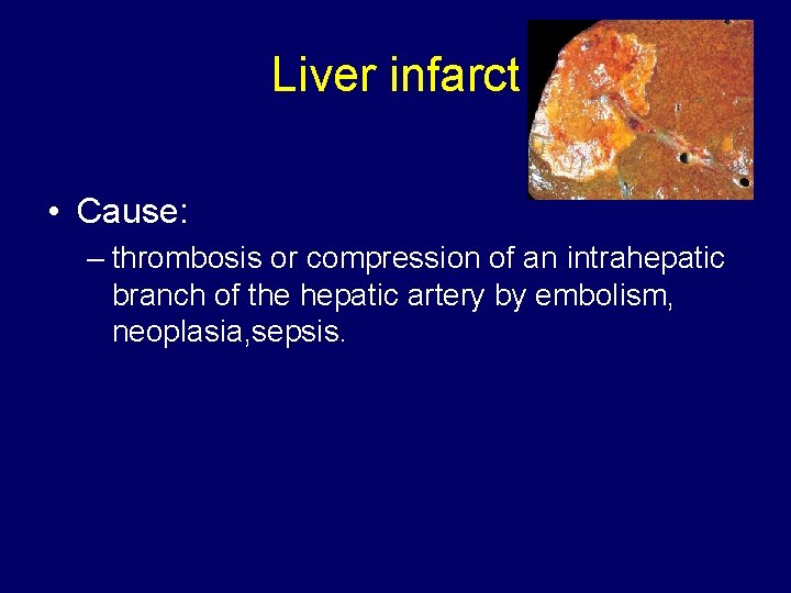 Liver infarct • Cause: – thrombosis or compression of an intrahepatic branch of the