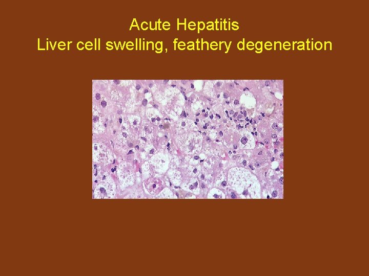 Acute Hepatitis Liver cell swelling, feathery degeneration 