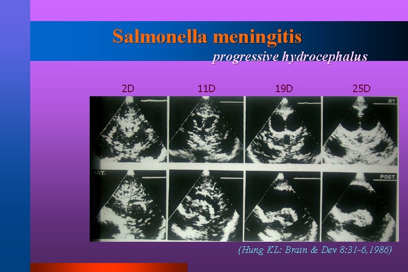 Salmonella meningitis progressive hydrocephalus 2 D 11 D 19 D 25 D (Hung KL: