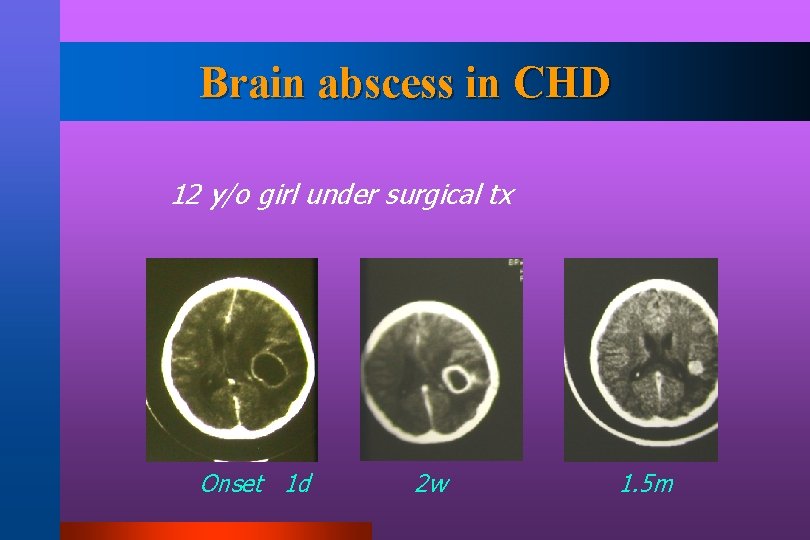 Brain abscess in CHD 12 y/o girl under surgical tx Onset 1 d 2
