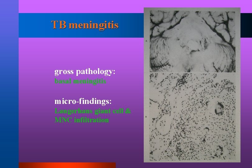 TB meningitis gross pathology: basal meningitis micro-findings: Langerhans giant cell & MNC infiltration 