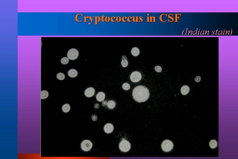 Cryptococcus in CSF (Indian stain) 