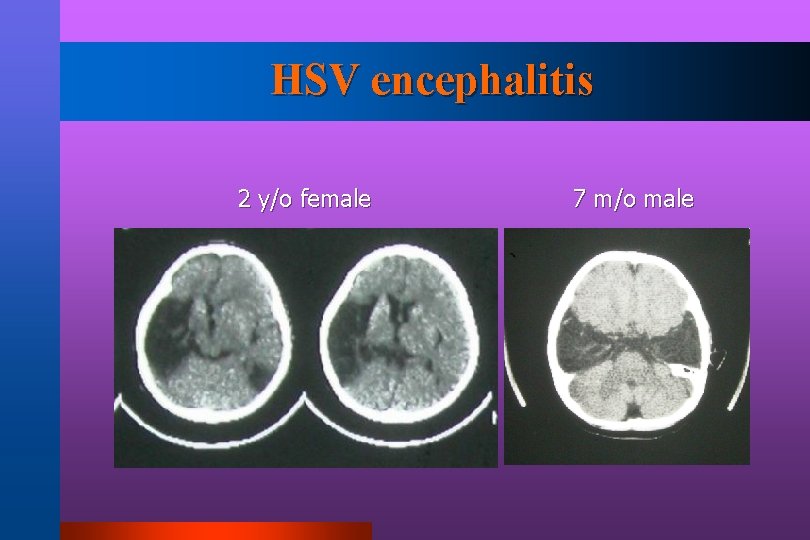 HSV encephalitis 2 y/o female 7 m/o male 