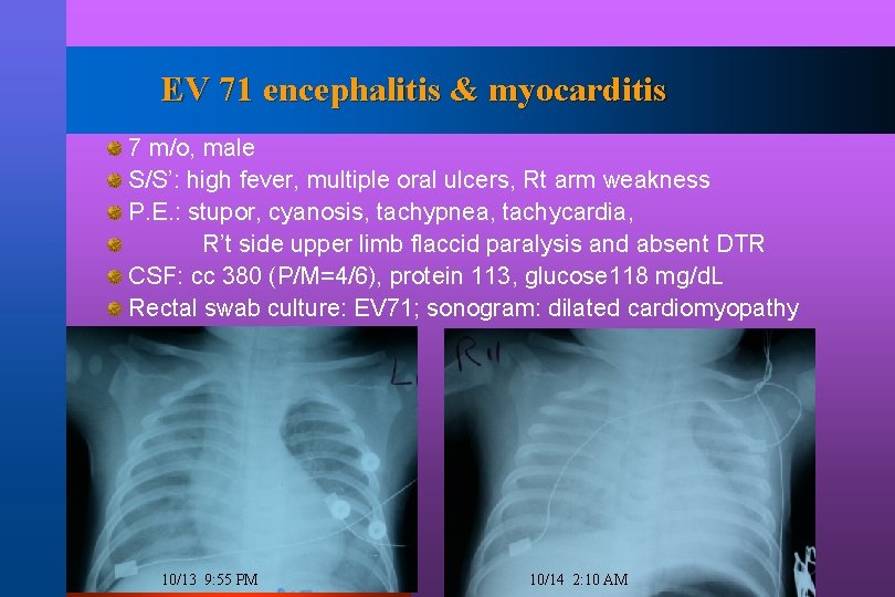 EV 71 encephalitis & myocarditis 7 m/o, male S/S’: high fever, multiple oral ulcers,