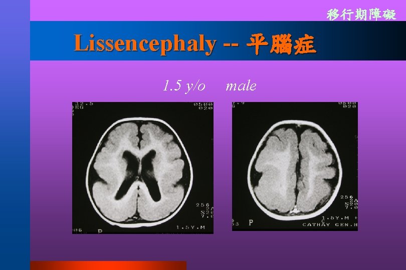 移行期障礙 Lissencephaly -- 平腦症 1. 5 y/o 　male 