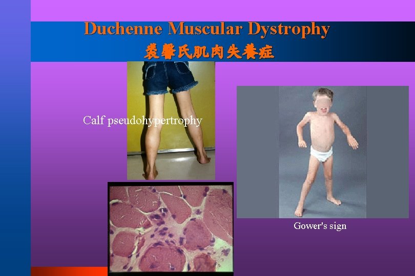 Duchenne Muscular Dystrophy 裘馨氏肌肉失養症 Calf pseudohypertrophy Gower's sign 