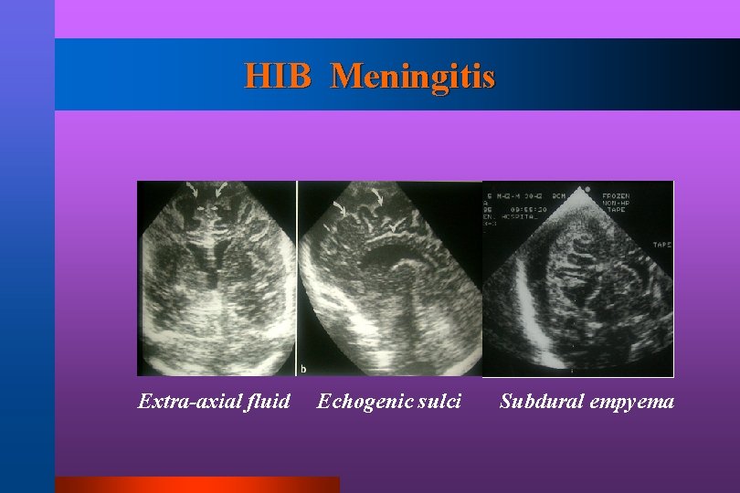 HIB Meningitis Extra-axial fluid Echogenic sulci Subdural empyema 