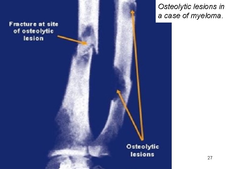 Osteolytic lesions in a case of myeloma. 27 