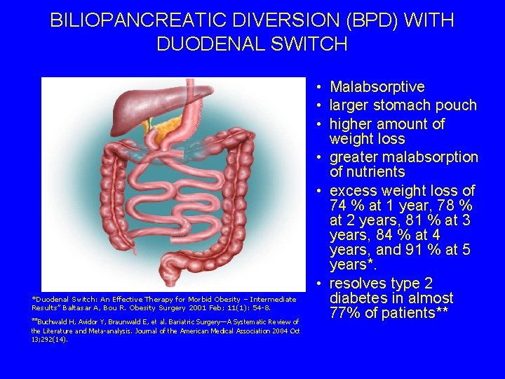 BILIOPANCREATIC DIVERSION (BPD) WITH DUODENAL SWITCH *Duodenal Switch: An Effective Therapy for Morbid Obesity