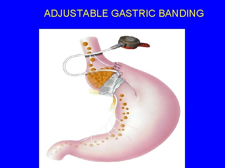 ADJUSTABLE GASTRIC BANDING 