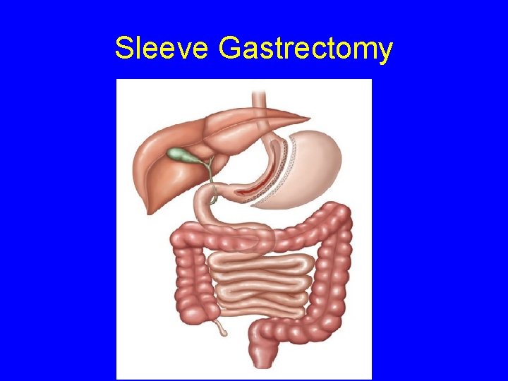 Sleeve Gastrectomy 