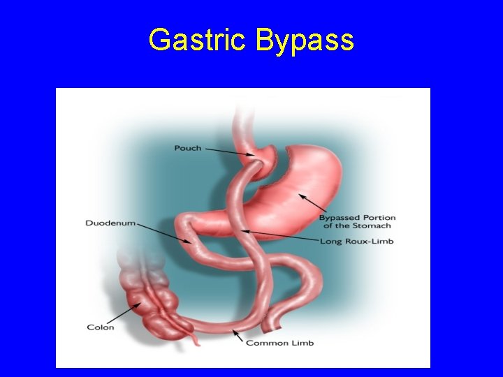 Gastric Bypass 