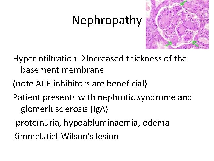 Nephropathy Hyperinfiltration Increased thickness of the basement membrane (note ACE inhibitors are beneficial) Patient