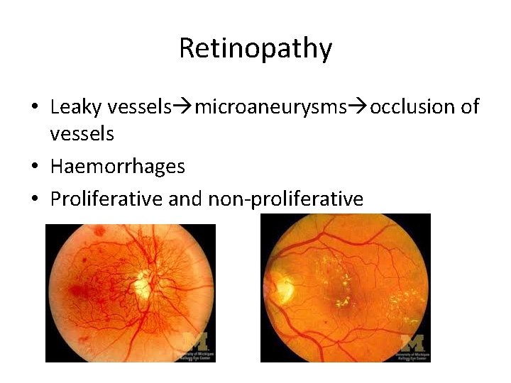 Retinopathy • Leaky vessels microaneurysms occlusion of vessels • Haemorrhages • Proliferative and non-proliferative