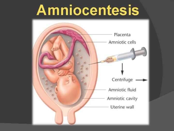 Amniocentesis 