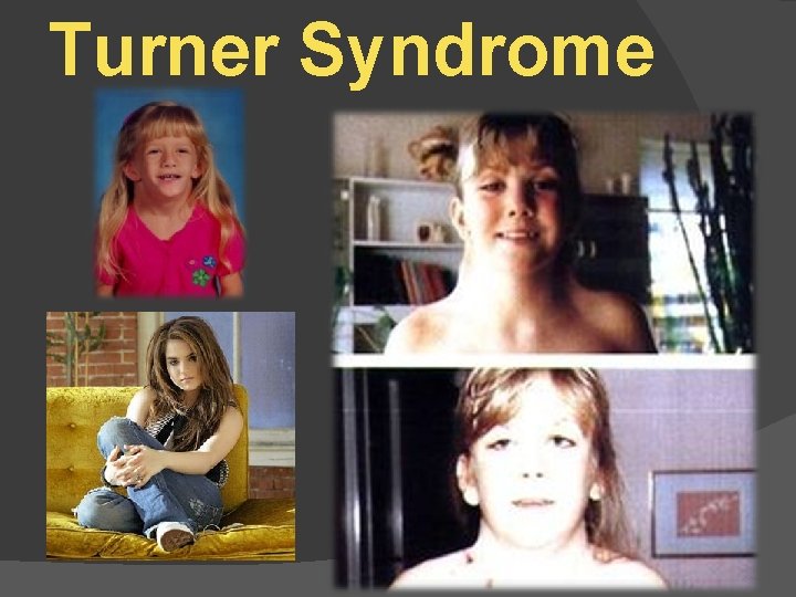 Turner Syndrome 