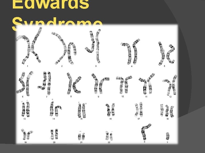 Edwards Syndrome 