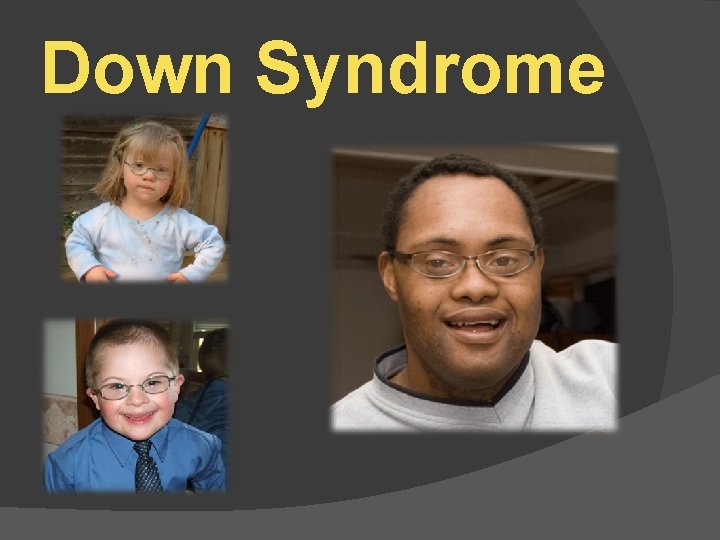 Down Syndrome 