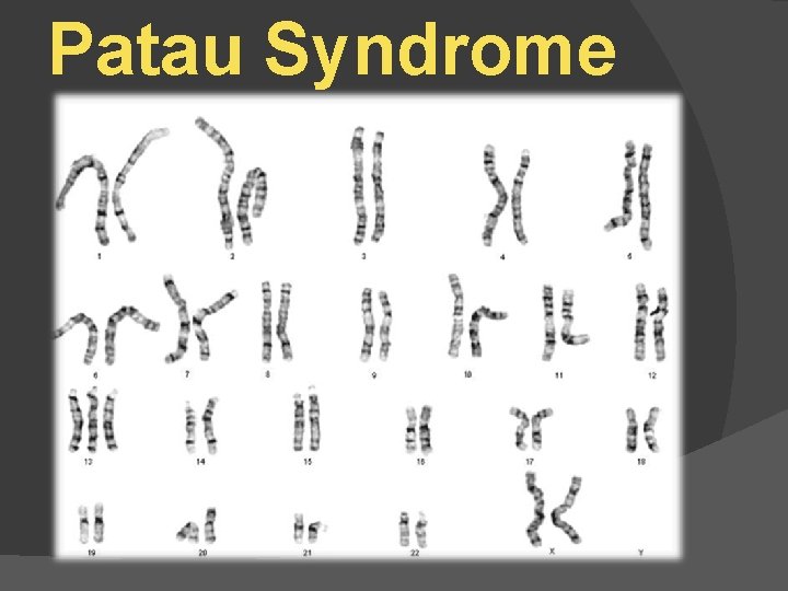 Patau Syndrome 