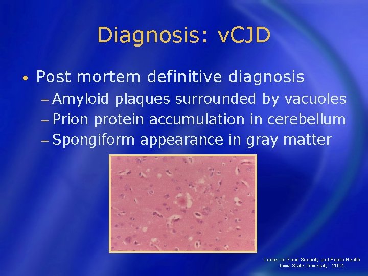 Diagnosis: v. CJD • Post mortem definitive diagnosis − Amyloid plaques surrounded by vacuoles