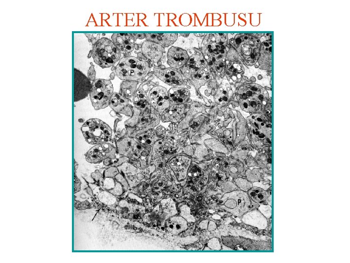 ARTER TROMBUSU 