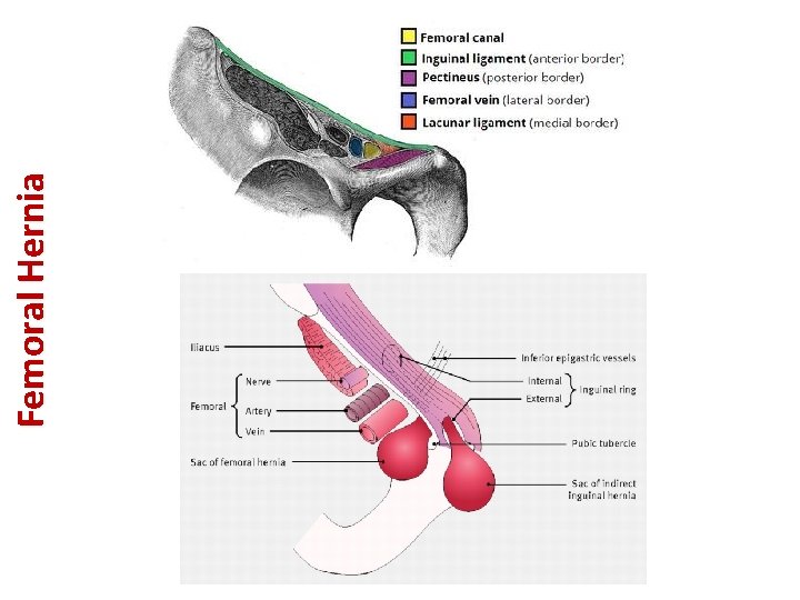 Femoral Hernia 