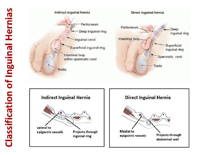 Classification of Inguinal Hernias 