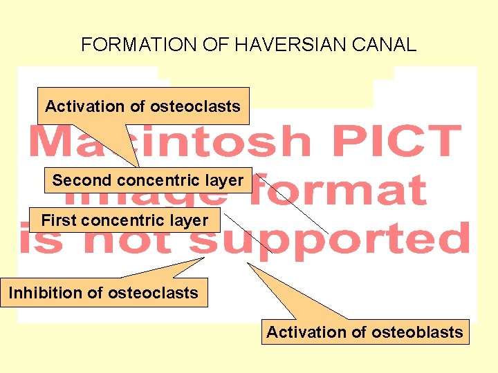 FORMATION OF HAVERSIAN CANAL Activation of osteoclasts Second concentric layer First concentric layer Inhibition