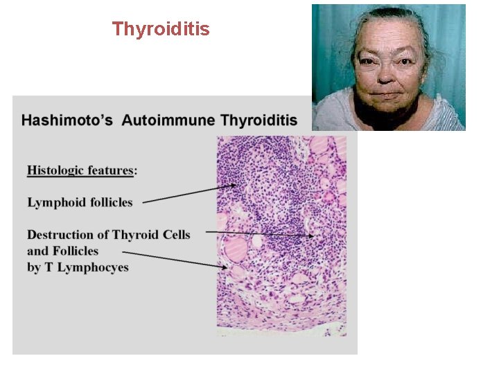 Thyroiditis 