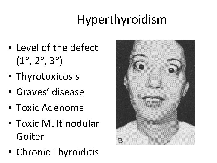 Hyperthyroidism • Level of the defect (1 , 2 , 3 ) • Thyrotoxicosis