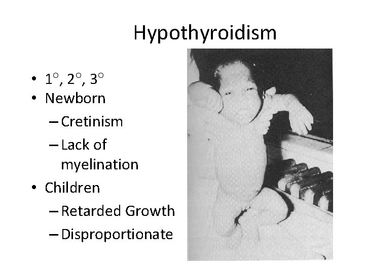 Hypothyroidism • 1 , 2 , 3 • Newborn – Cretinism – Lack of